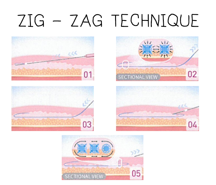 zigzag technique tesslift_soft